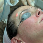 Sun Damage Treatment - Laser Skin Resurfacing
