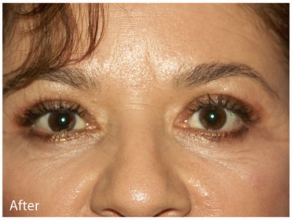 Blepharoplasty Before & After Patient #3823