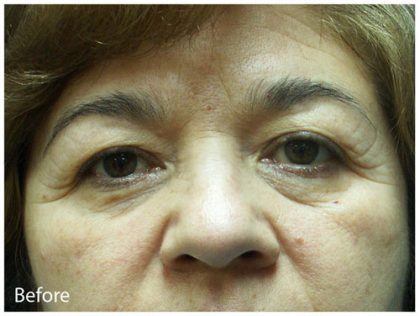 Blepharoplasty Before & After Patient #3823