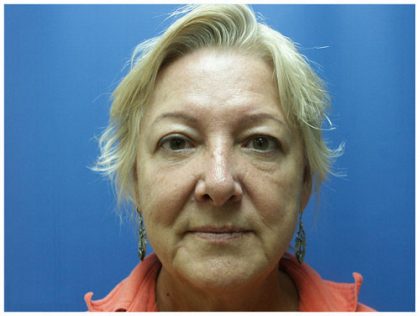 Blepharoplasty Before & After Patient #3830