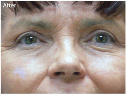 Blepharoplasty Before & After Patient #3835