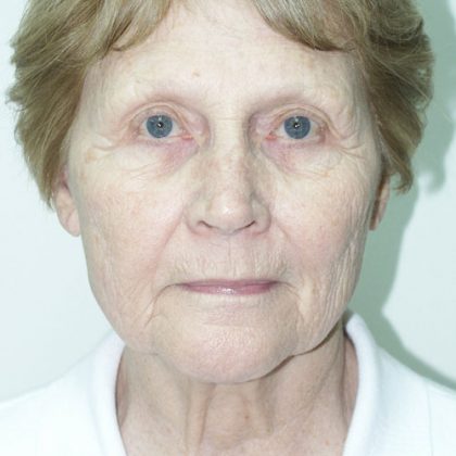 Facelift Before & After Patient #3838