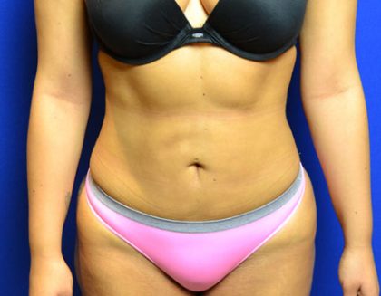 Liposuction Before & After Patient #3954