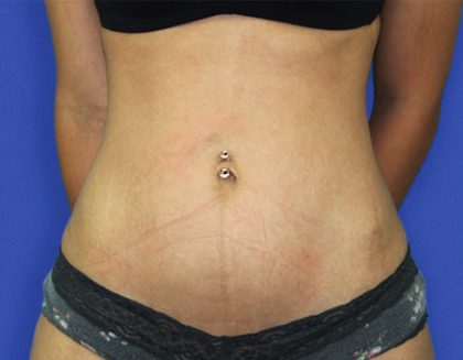 Liposuction Before & After Patient #3957