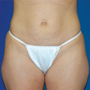 Liposuction Before & After Patient #3964