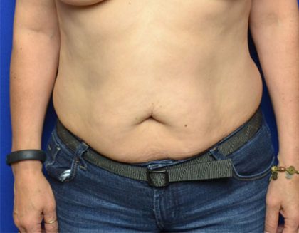 Tummy Tuck Before & After Patient #3816