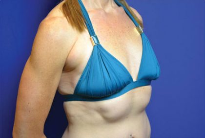Breast Augmentation Before & After Patient #4108