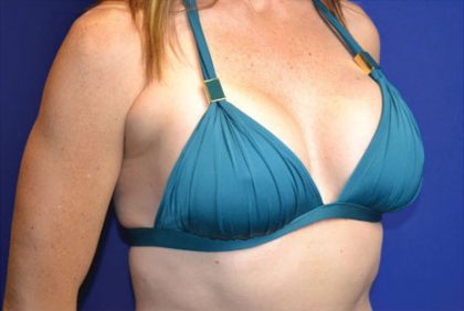 Breast Augmentation Before & After Patient #4108